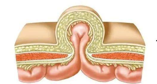 国产疝气补片发展史视频,国产疝气补片发展历程回顾